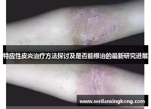 特应性皮炎治疗方法探讨及是否能根治的最新研究进展 特应性皮炎治疗方法探讨及是否能根治的最新研究进展
